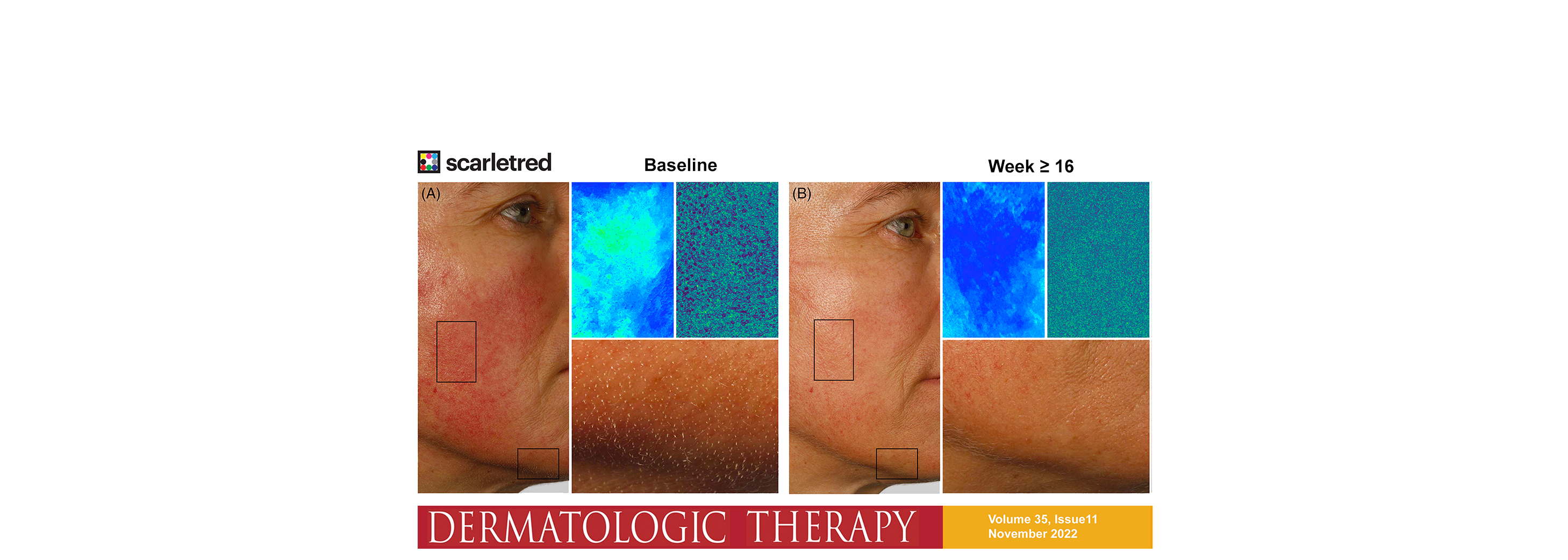 SCARLETRED - New Publication: Ivermectin Treatment in Rosacea - Modern Flea Allergy Dermatitis Treatment With Ivermectin
